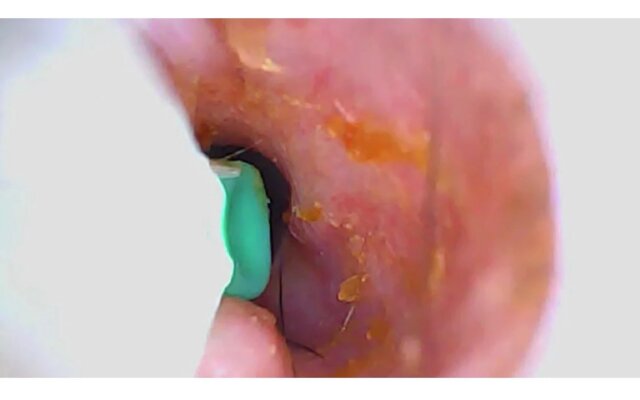 SmartScope Visual Ear Cleaner
