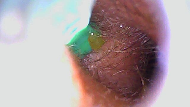 SmartScope Visual Ear Cleaner