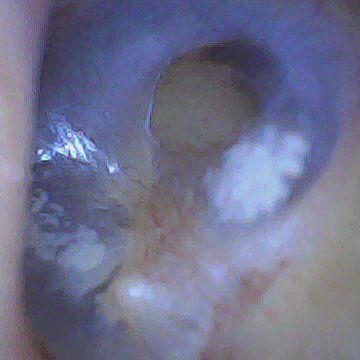 SmartScope Visual Ear Cleaner